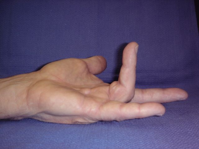 Dupuytren’s Contracture