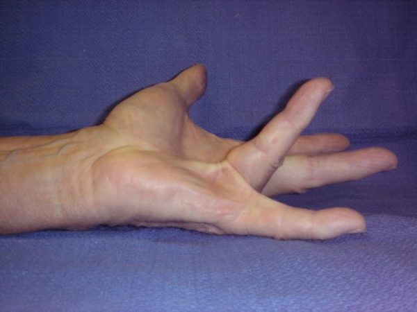 Dupuytrens Disease Treatment