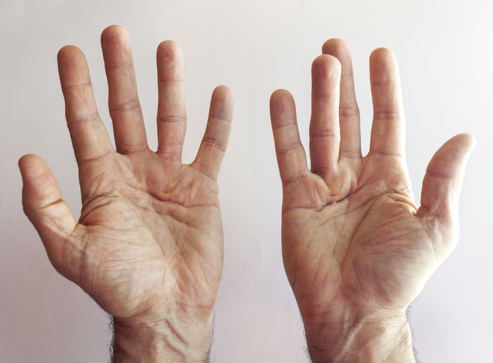 curved fingers, dupuytren's disease